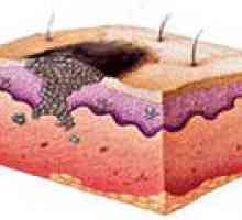 Maligni tumorji na koži