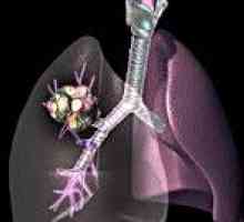 Maligni pljučni tumorji