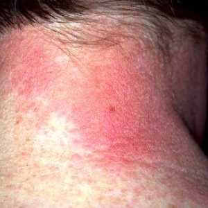 Alergijski dermatitis: Simptomi in zdravljenje