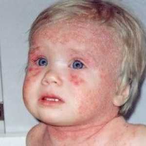 Atopijski dermatitis pri odraslih in otrocih