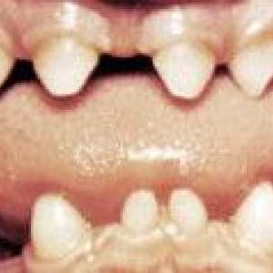 Nenormalnosti obliki zob