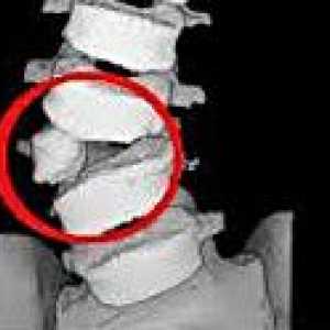 Anomalije hrbtenice
