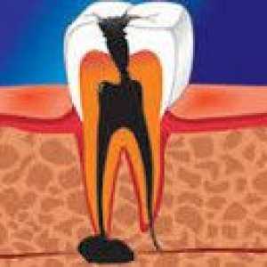 Apical periodontitis