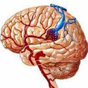 Arteriovenske malformacije možganov
