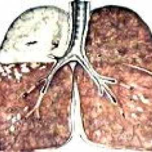 Bakterijski uničenje pljuč
