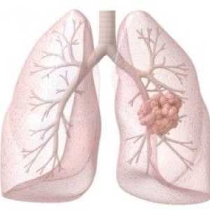 Diagnoza in zdravljenje pljučnega raka