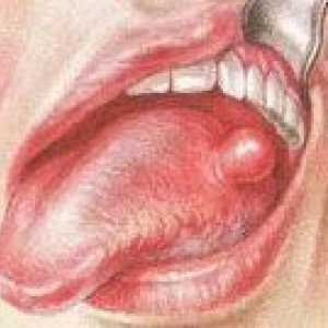 Benigni tumorji jezik