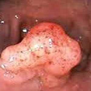 Benignih tumorjev debelega črevesa