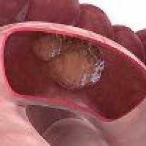 Benignih tumorjev v tankem črevesu