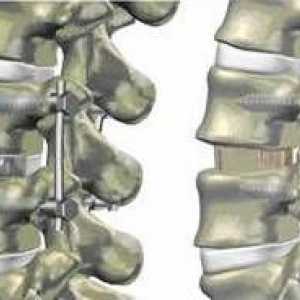 Hrbtenice fiksiranje v spondilolisteze, zmanjšanje višine medvretenčnih diskov