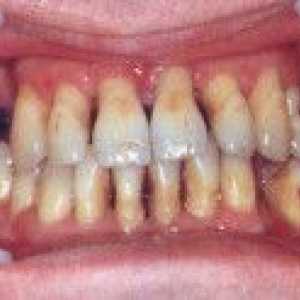 Generalizirana periodontitis