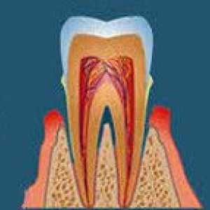 Kronični periodontitis