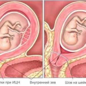 Materničnega vratu nesposobnost (CIN) med nosečnostjo