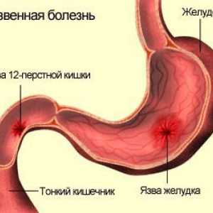 Razjede (peptičnega ulkusa), želodec in dvanajsternik