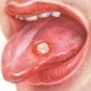 Ulcerozni stomatitis