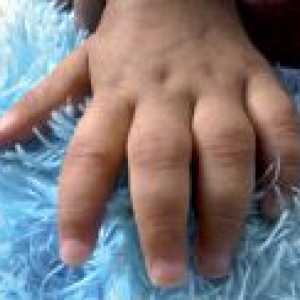 Juvenilni revmatoidni artritis