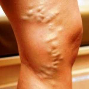 Kako za zdravljenje krčne žile na nogah