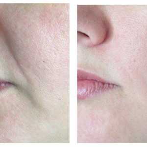 Kako odstraniti nosno-ustnične gube?