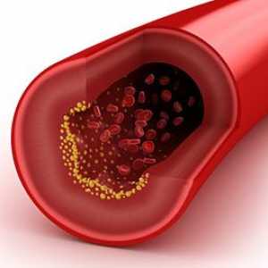 Kako zmanjšati raven holesterola v krvi?