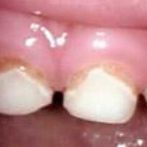 Zdravljenje primarnih zob
