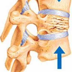 Kyphoplasty, zdravljenje z vertebroplasty zloma stiskanja hrbtenica telesa