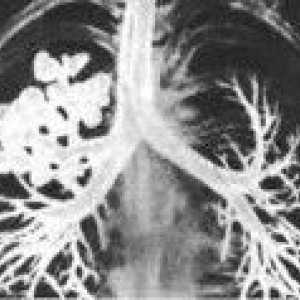 Cistična pljuč hipoplaziji