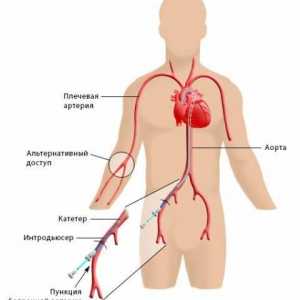 Koronarno angiografijo (koronarno)