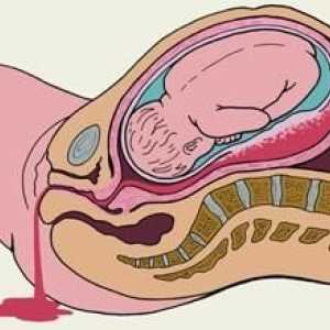 Krvavitev med nosečnostjo v zgodnjih in poznih fazah