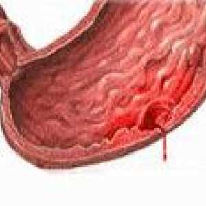 Želodčna razjeda krvavitev