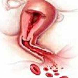 Krvavitev iz maternice