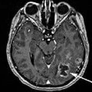 Metastatskim možganskih tumorjev