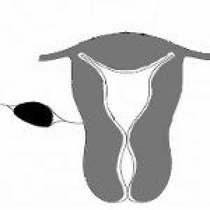 Mezhsvyazochnaya fibroidi