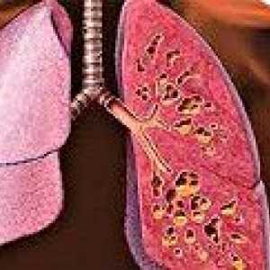 Cistična fibroza pljuč