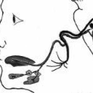 Nevralgija submandibularnega in podjezične vozlišča