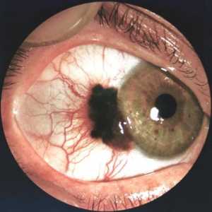 Tumorji očesa