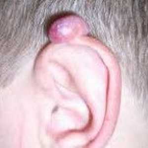 Tumorji ušesa