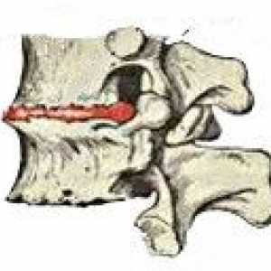 Osteohondroza