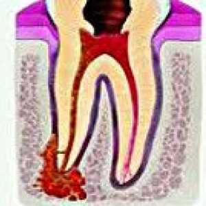 Akutna periodontitis