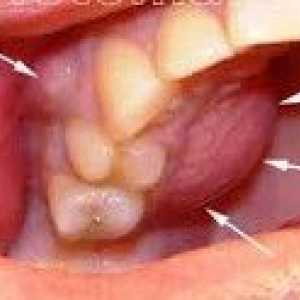Periostitisa od čeljusti