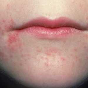 Ustni dermatitis