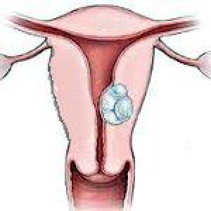 Submukozno fibroidi