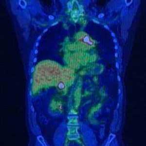 Pozitronsko emisijsko tomografijo (PET)