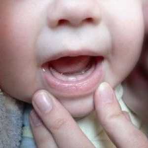 Znaki zob pri dojenčkih