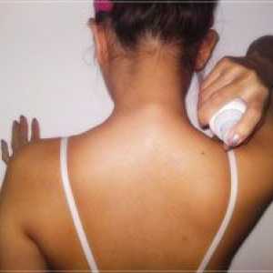 Akne na hrbtu in ramenih
