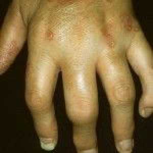 Psoriatični artritis