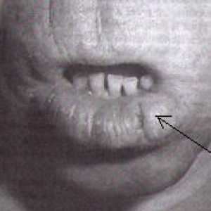 Rak ustnic, ustne votline in žrela (žrela)