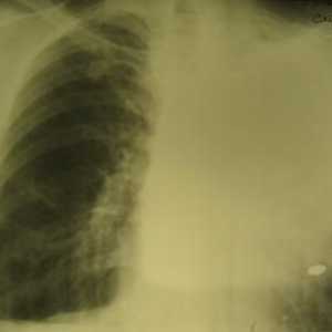 Pljučni rak