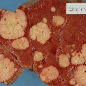 Rak jeter: Simptomi in diagnoza