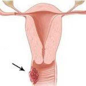 Vaginalni rak