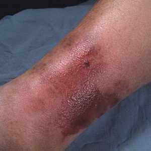 Rdečica noge: Simptomi in zdravljenje